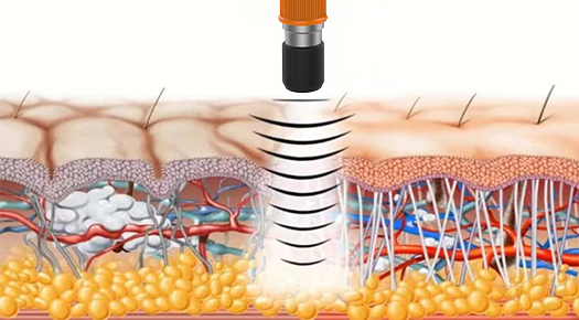 SHOCK WAVE THERAPY