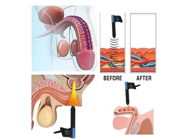 Shockwave ED treatment