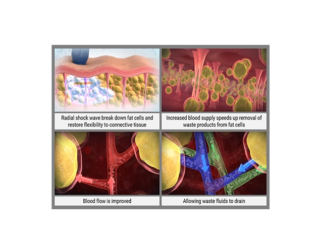 Shockwave Cellulite Reduction