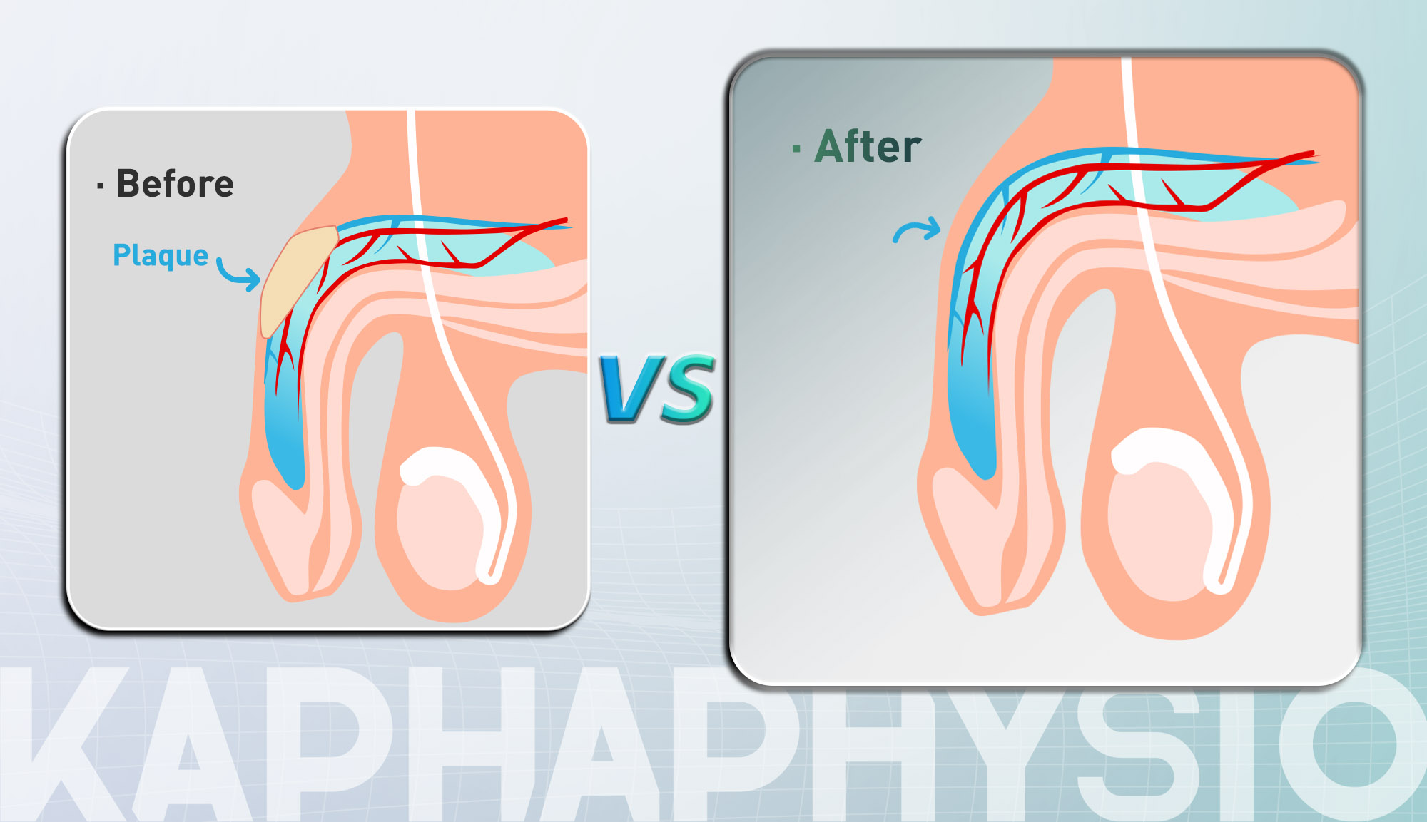 shockwave-therapy-increase-size.jpg