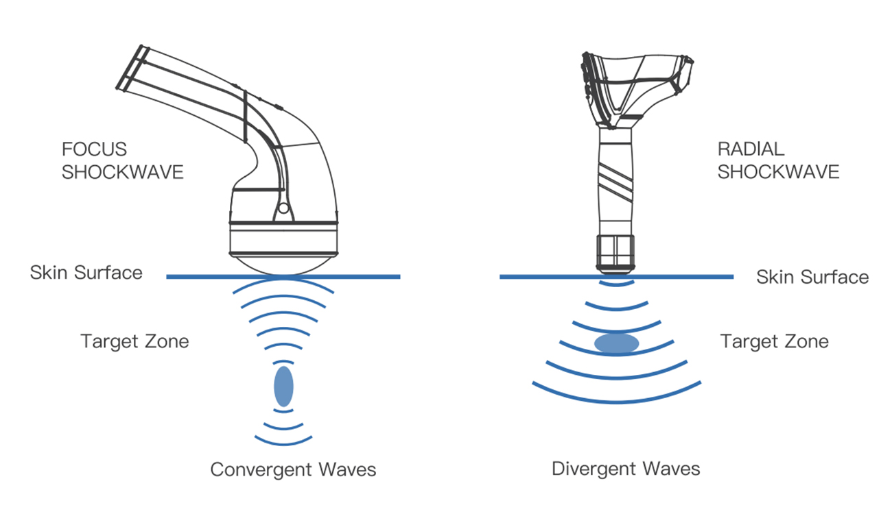 Radial-shockwave VS Focus-shockwave.jpg