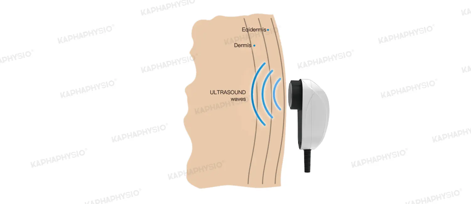 ultrasound-therapy(2).webp